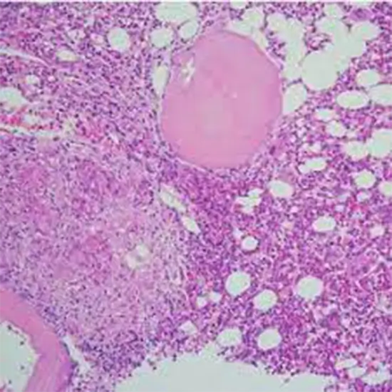 bone marrow trephine biopsy panel